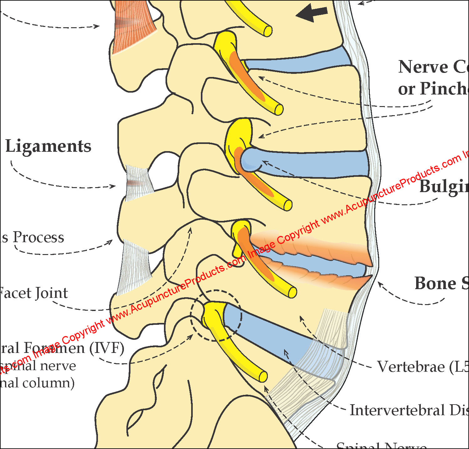Lumbar Spinal Degeneration