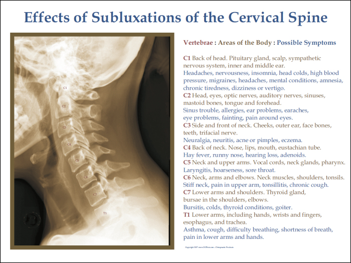 cervical Spine Subluxations
